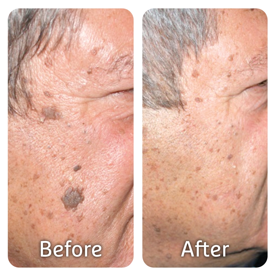 PICS Before After MED10