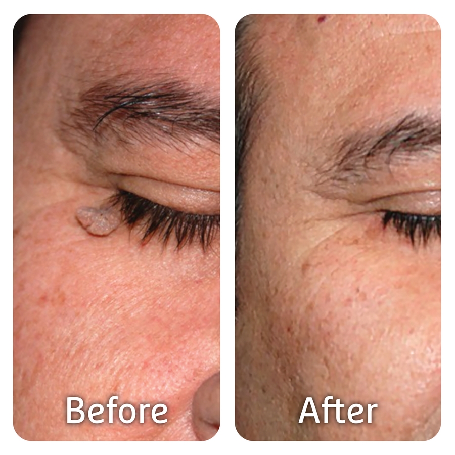 PICS Before After MED12