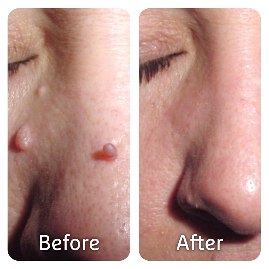 PICS Before After MED4